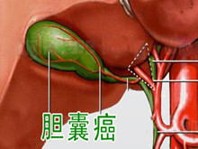 胆囊癌