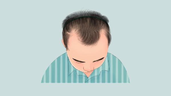 发际线后移怎么回事,怎么办