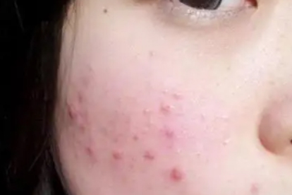 皮肤癌到最后人都是咋没的？医生无奈：多半是这3个症状没重视