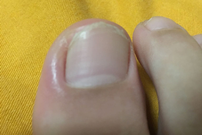 甲沟炎肿了吃什么消炎药