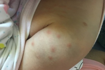 毛囊炎中药治疗方法
