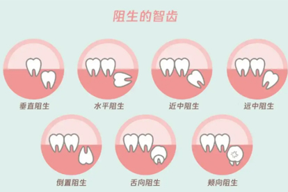 智齿疼连着嗓子咽口水疼