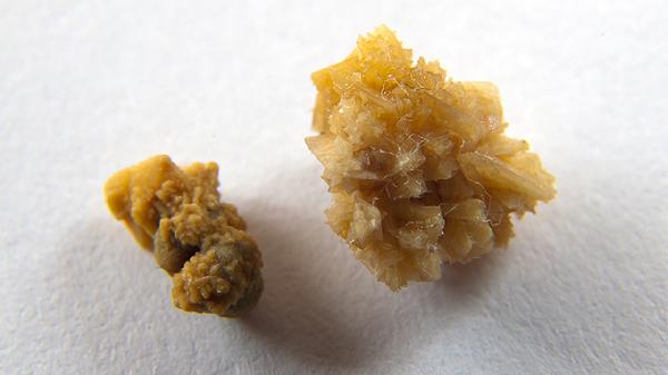 结石进入膀胱有什么感觉