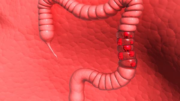 结肠炎有哪些症状、治疗方法是什么