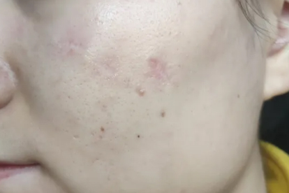 红蓝光照痘印有效果吗