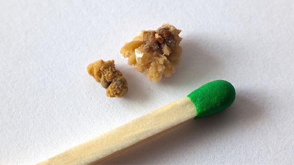 肺结石怎么手术治疗
