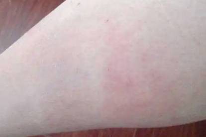 青霉素过敏能吃复方氨酚烷胺胶囊吗