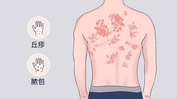 隐形皮肤病是什么症状引起的