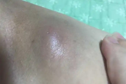 皮脂腺囊肿怎样治疗